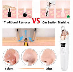 5-in-1 Blackhead Remover Machine – Rechargeable